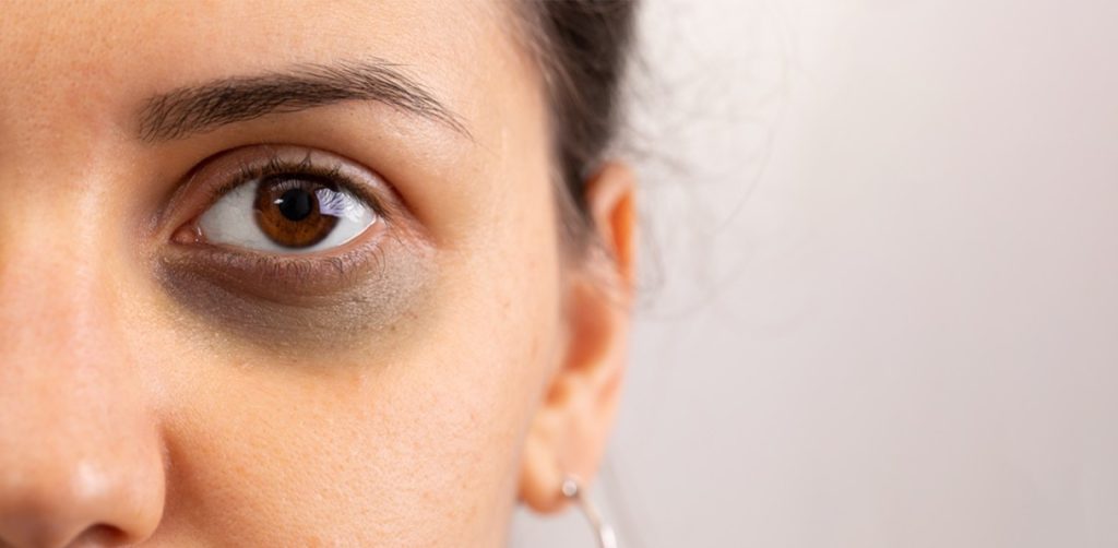 Dark Circles: Their Types, Causes, and their Treatment